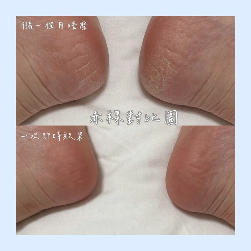 磨腳皮第一名好物